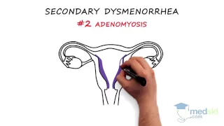 Obstetrics and Gynecology – Dysmenorrhea: By Paul Davies M.D.