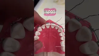 Descubre para que te ponen estas ligaduras de metal en tus Brackets!! 🤔🤔