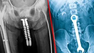 Most BIZARRE Things Found By X-Rays!