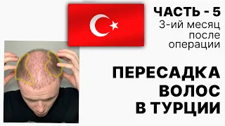 Пересадка волос в Турции. Часть-5 (3-ий месяц после операции)