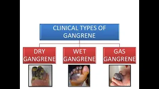Gangrene , Gas Gangrene , Wet Gangrene , Dry Gangrene treatment in Pakistan