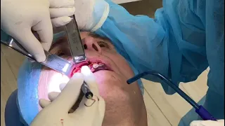 Video opening of the sinus lift