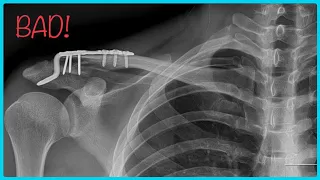 Welcome to the Broken Clavicle Club!