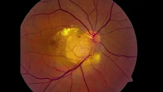 RET06 06   Section III My Best Medical Retina Cases   Case Presentation