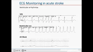 Cardiac complications in acute stroke