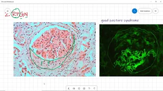 Glomerular diseases | Nephritic syndrome | PSGN, RPGN, DPGN, Alport, IgA Nephropathy