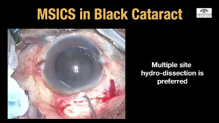 Black cataract