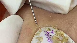 Loan Nguyen Acne Treatment (#107)