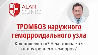 Тромбоз наружного геморроидального узла: как появляется, чем отличается от внутреннего геморроя