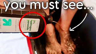 Put Hydrogen Peroxide on your FEET & SEE WHAT HAPPENS! 💥 (Hacks That Will Save You Money!)