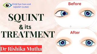 Squint specialist in indore / Squint and it's treatment