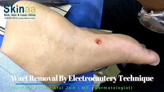 Foot Wart Removal by Electrocautery | Skinaa Clinic | Jaipur