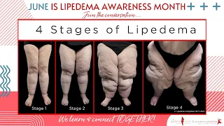 Lipedema Awareness Month - A Quick Look at the Fat/Lymphatic Disorder Lipedema