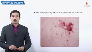 Hemangiopericytoma - Pathology USMLE Step 1