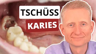 Die Karies-Vermeidungs-Formel: 6 einfache Tipps für gesunde Zähne