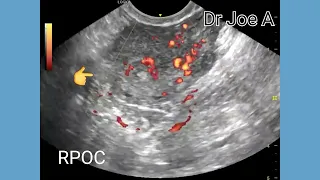 RPOC or retained products of conception, incomplete abortion, ultrasound, color, spectral Doppler