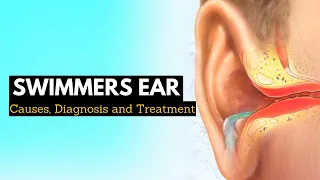 Say Goodbye to Swimmer's Ear: Effective Treatment Options