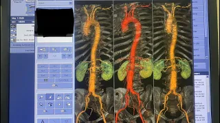 CT Angiography Thoracic &Abdominal Aorta Patient With Abdominal aneurysm(GE OPTIMA CT Multislice 16)