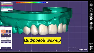 EXOCAD Моделировка waxup для дальнейшей печати модели. Цифровое моделирование зубов.