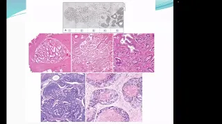 Carcinoma prostate part 1( aetiopathogenesis, histopathology, spread, diagnosis & staging)