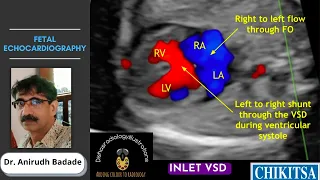 Fetal Echocardiography Basics [Ultrasound] | Dr. Anirudh Badade