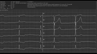 Akuutti Sydän - Mitä EKG kertoo? Tampere Lääketiedepäivät 2021 luento