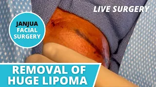 REMOVAL OF HUGE LIPOMA (LIVE SURGERY) - DR. TANVEER JANJUA - NEW JERSEY