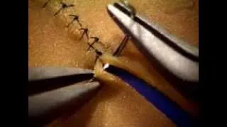 Basic Microsuture Technique