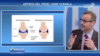 Il Mio Medico - Artrosi del piede: come curarla