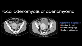 Imaging of the female pelvis II   DRE 2   Dr Mamdouh Mahfouz 720p