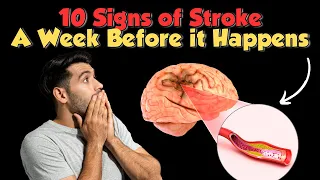 Discover the 10 Warning Signs of Stroke a Week Before It Happens!