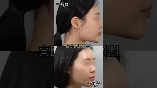 10년경력 피부과의사의 풀페이스필러 🧡