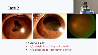 AIOC2022   IC5   Dr  Kalpana Babu Murthy Sarcoid Uveitis   Is It Underdiagnosed In Our Country