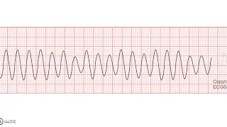 Ventricular Flutter