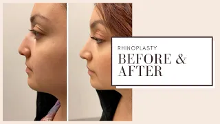 Plastic Surgery Before & After | Rhinoplasty | ESKMD NYC