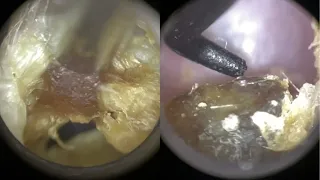 167 - Dead Skin Extracted from Ear with False Fundus using Forceps & Angled Rai Hook with WAXscope®️