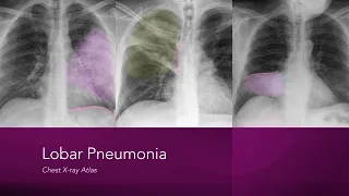 Lobar Pneumonia: Chest X-ray Atlas