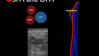 Video 18   Tutorial on ultrasound for DVT