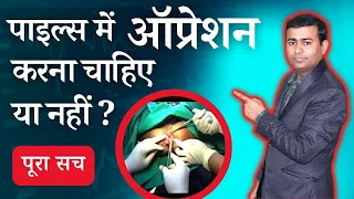 पाइल्स में ऑप्रेशन करना चाहिए या नहीं ? पूरा सच when do piles need surgery #piles #pilesclinic