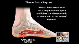 Rupture of the  Plantar Fascia  - Everything You Need To Know - Dr. Nabil Ebraheim