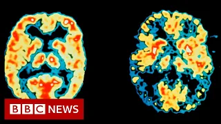 US approves first new Alzheimer's drug in 20 years - BBC News