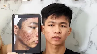 Skin improvement after 5 treatments at hien van spa|367|Duy Tan