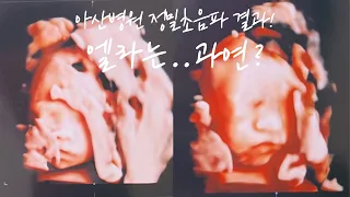 Ella's 4D Ultrasound Face Ver.2👶🏻 | Settle Down After Moving to Korea