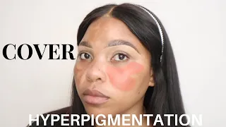 COLOR CORRECTING HYPERPIGMENTATION & MELASMA