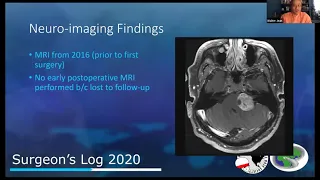 S1E2: The Bridges of Mastoid County (Vestibular Schwannoma)