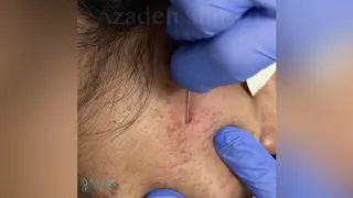 Acne Scar Subcision