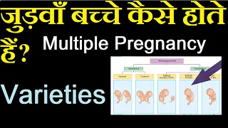 Varieties & Incidences in Multiple Pregnancy in Hindi |  Nursing Lecture