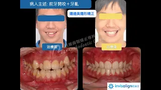 貝爾牙齒矯正專科診所之隱適美拔牙矯正