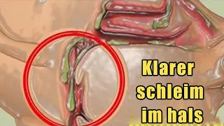 Wie du Schleim in deinem Hals in 2 Minuten loswirst  du wirst es nicht bereuen