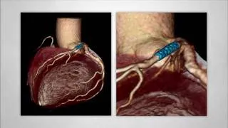 Aquilion ONE, Dynamic Volume Cardiac CT